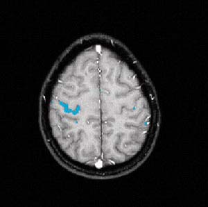 позитронно-эмиссионная томография мозга